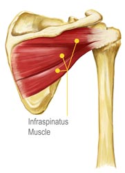Infraspinatus